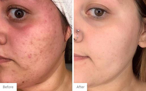 3 - Before and After Real Results photo of a woman's use of Neora's Acne Complexion Treatment Pads