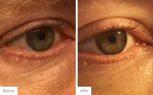 4 - Before and After Real Results photo of a woman's eye area.