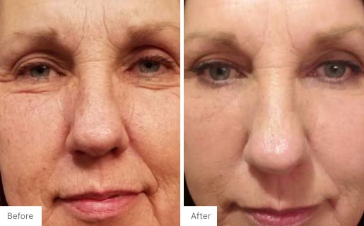 10 - Before and After Real Results image for Age IQ Night Cream