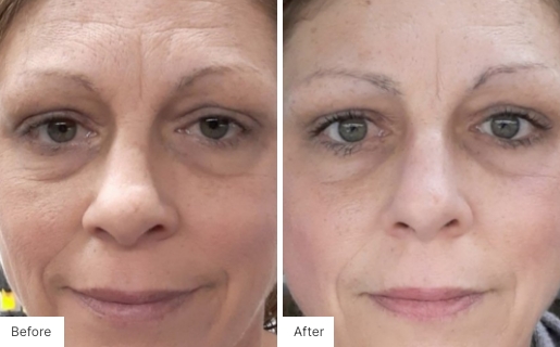 4 - Before and After Real Results photo of a woman's face.