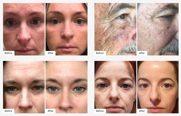 Image of before and after Real Results from using the night, day and cleanser combo.
